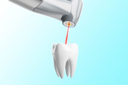 Bohren mit dem Dental-Laser