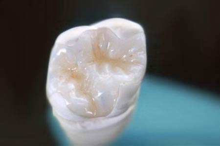 Strahlend weiße Zähne - ein Inlay aus Keramik